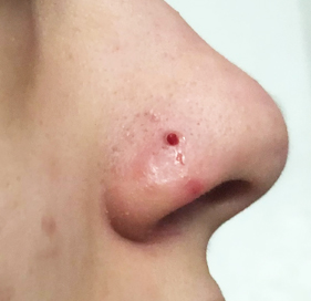 nose-pin-hole-repair-in-delhi