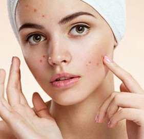 acne treatment in delhi, Best acne treatment in west delhi, Best acne treatment in delhi, Best dermal fillers in delhi, Prp treatment for acne scars