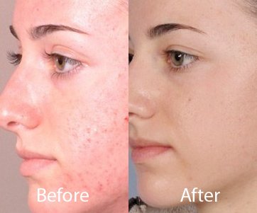  best microdermabrasion clinics in delhi