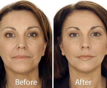 non surgical skin lift in delhi