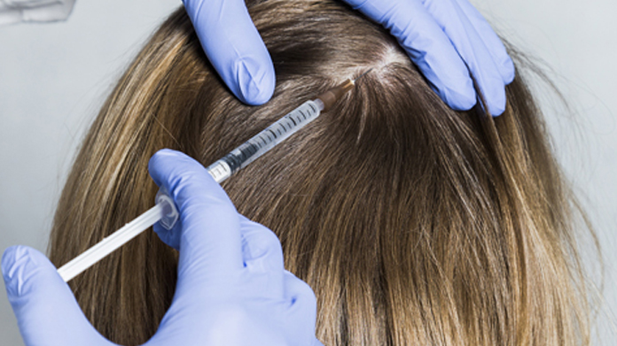 PRP Treatment for Hair Loss - Look Young Clinic