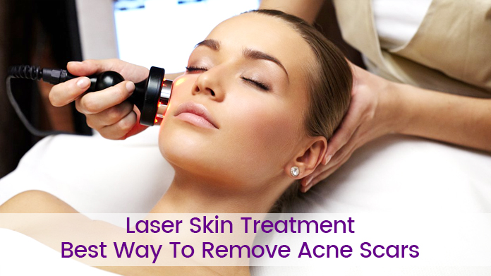 acne scar treatment, acne scar treatment procedure, Best acne treatment in delhi, Microneedling for acne scar, laser treatment, Acne treatment, Prp treatment for acne scars