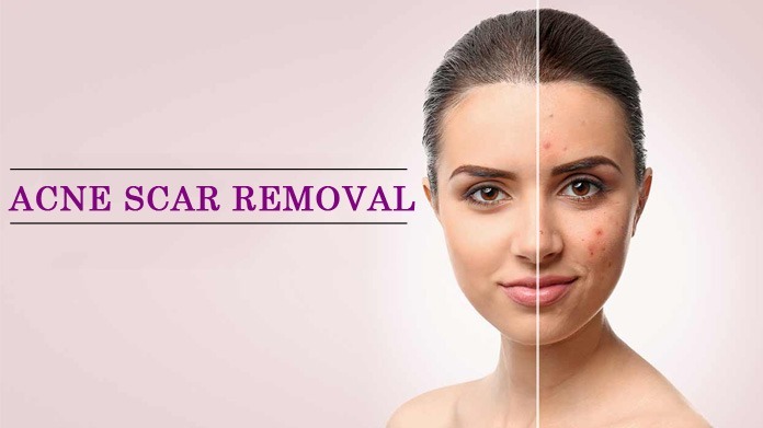 acne removal treatment, acne scar removal, acne scar removal treatment, acne scar treatment, Acne treatment, Botox Treatment, microdermabrasion treatment, removal of acne scar