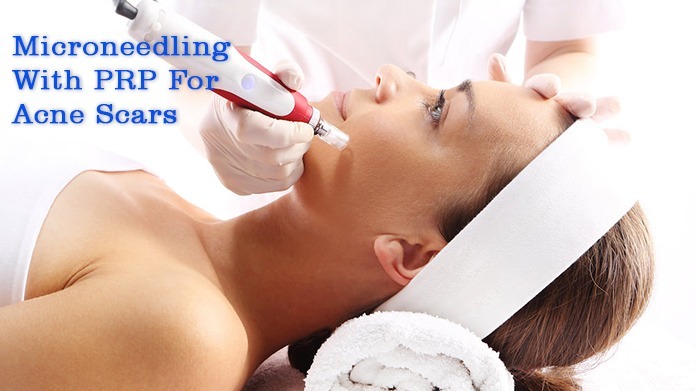 Microneedling With PRP For Acne Scars