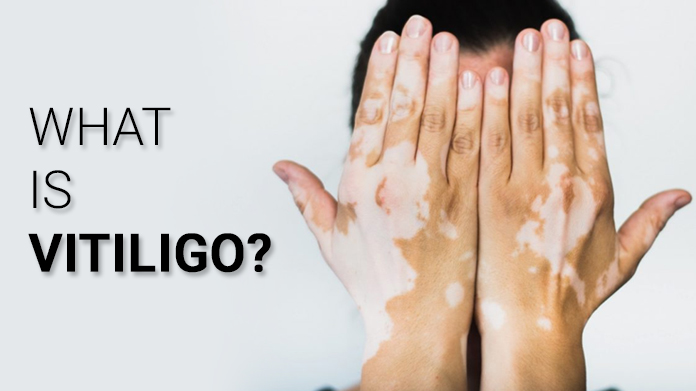 What is vitiligo