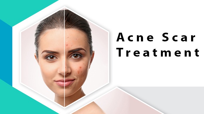 Acne Scar Treatment