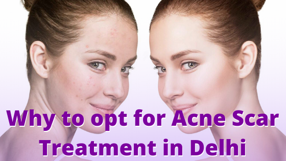 acne scar treamtment in delhi