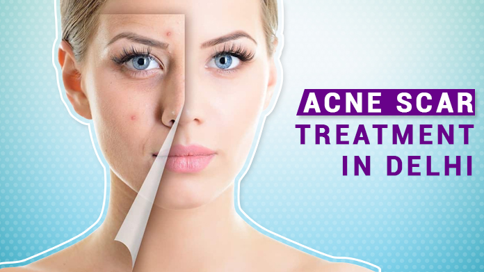 Best AcneScar Treatment in Delhi