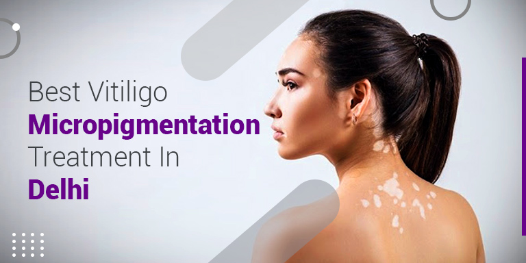 Vitiligo Micro-Pigmentation Treatment in Delhi