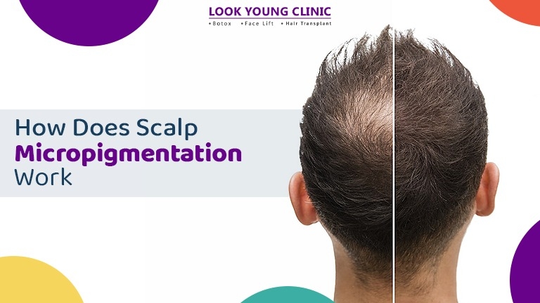 scalp micropigmentation in Delhi