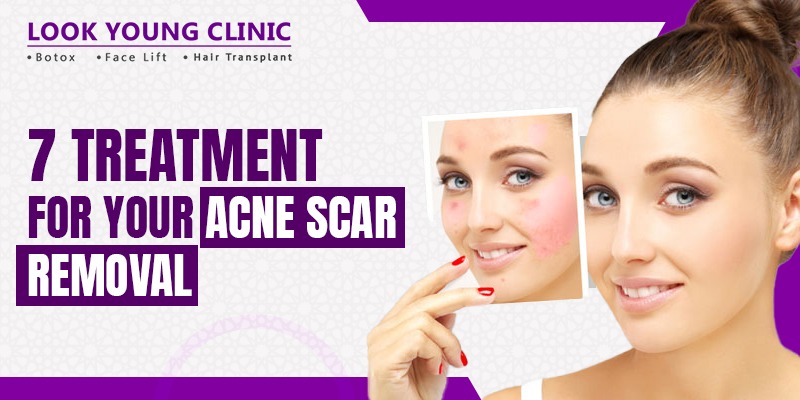 Acne scar treatments