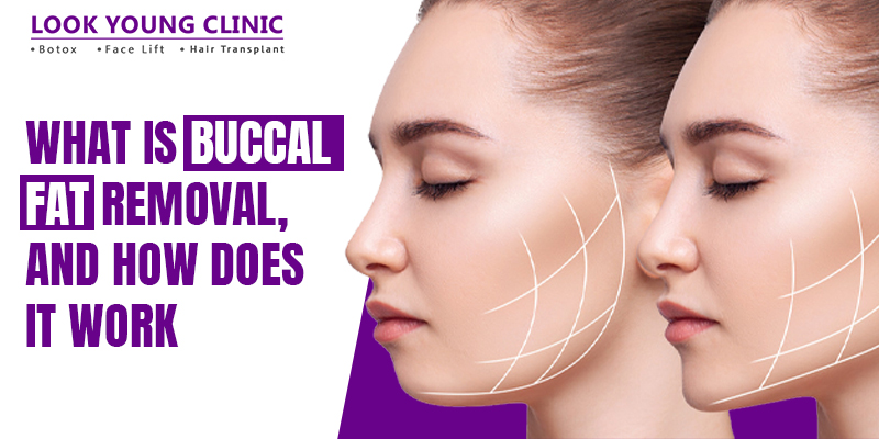 buccal fat reduction surgery