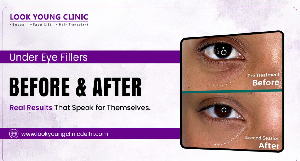 Undereye fillers
