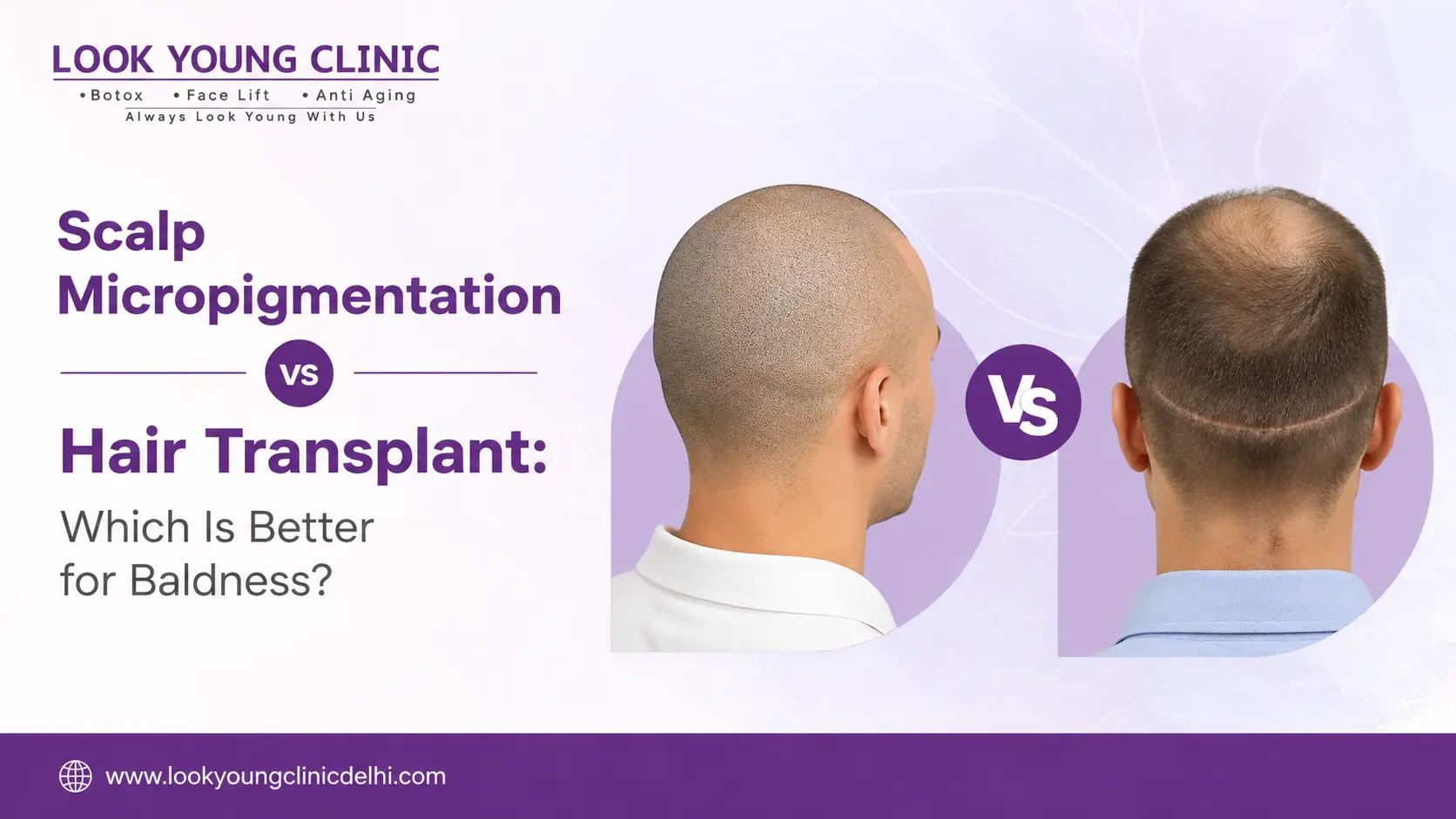 Scalp Micropigmentation vs Hair Transplant: Which Is Better for Baldness?