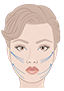 Dermal Fillers Treatment in Delhi, Dermal Fillers, dermal filler treatment, dermal fillers in delhi