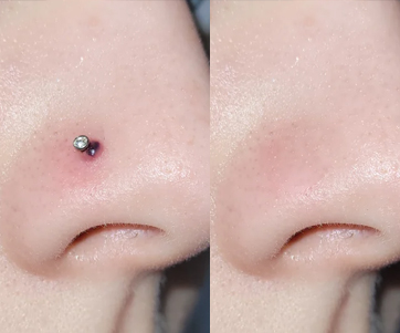  nose-pin-hole-repair-testimonial