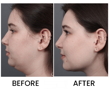 Buccal Fat Reduction Surgery in delhi