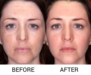 microneedling for acne scars in delhi