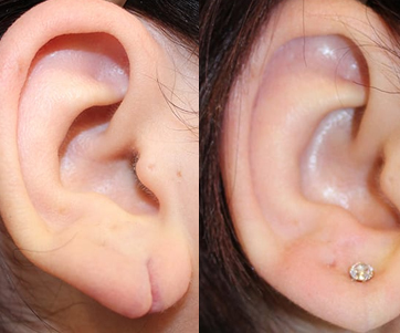 Earlobe-testimonial