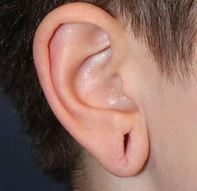 Earlobe-Repair-in-Delhi