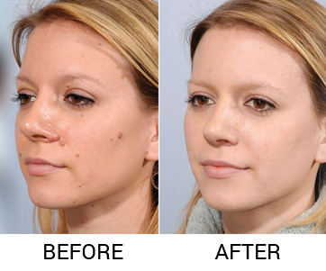 micropigmentation in delhi