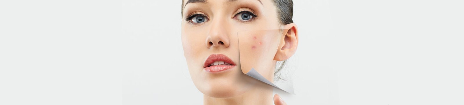 acne treatment clinic in delhi