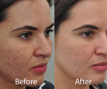 microneedling for acne scars in delhi