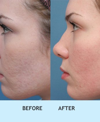 acne scar treatment in delhi, Best acne treatment in west delhi, Best acne treatment in delhi, Best dermal fillers in delhi, Prp treatment for acne scars