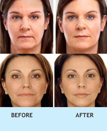 anti-ageing treatment in delhi, Anti ageing clinic india, Anti ageing treatment in delhi, Anti aging treatment in india, Laser skin tightening treatment india