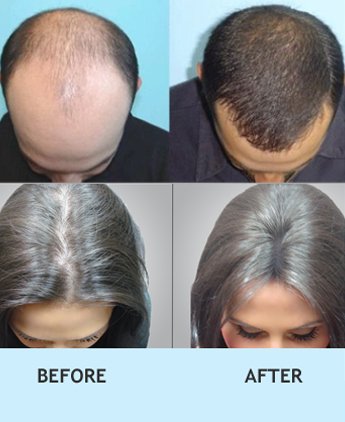hair regrowth treatment in delhi, Botox hair treatment in rajouri garden, Best hair regrowth treatment in delhi