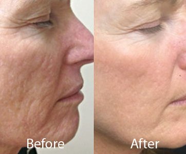 best microneedling for acne scars in delhi 