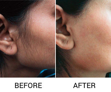 micropigmentation in delhi