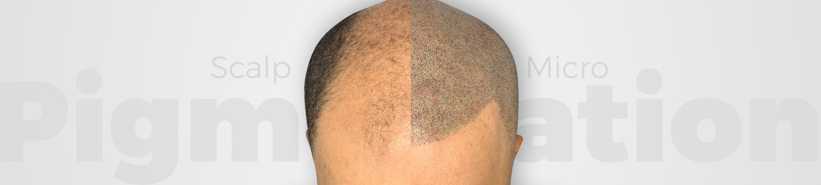 Scalp Micropigmentation clinic in delhi