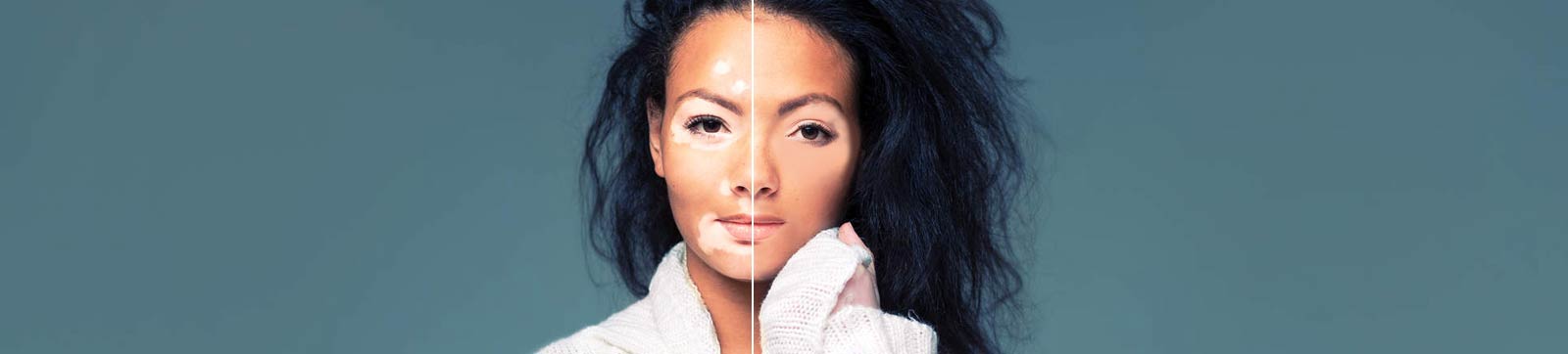 best vitiligo treatment in delhi