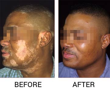 best vitiligo treatment in delhi, vitiligo treatment in delhi, vitiligo treatment in india, best vitiligo treatment in india