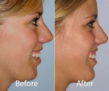 facial filler clinic in delhi