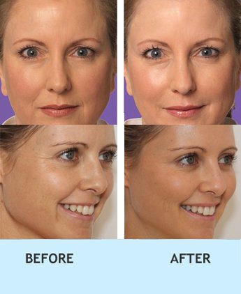 facial volume enhancement in delhi, Cheek enhancement fillers cost in rajouri garden, Cheek enhancement fillers in Delhi, botox treating wrinkles