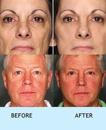 wrinkle treatment in delhi, Best wrinkle filler for lines around mouth in rajouri garden, Treatment for smile lines around mouth, Non surgical wrinkle treatment in rajouri garden, Treatment for smile lines around mouth, Non surgical wrinkle treatment in delhi