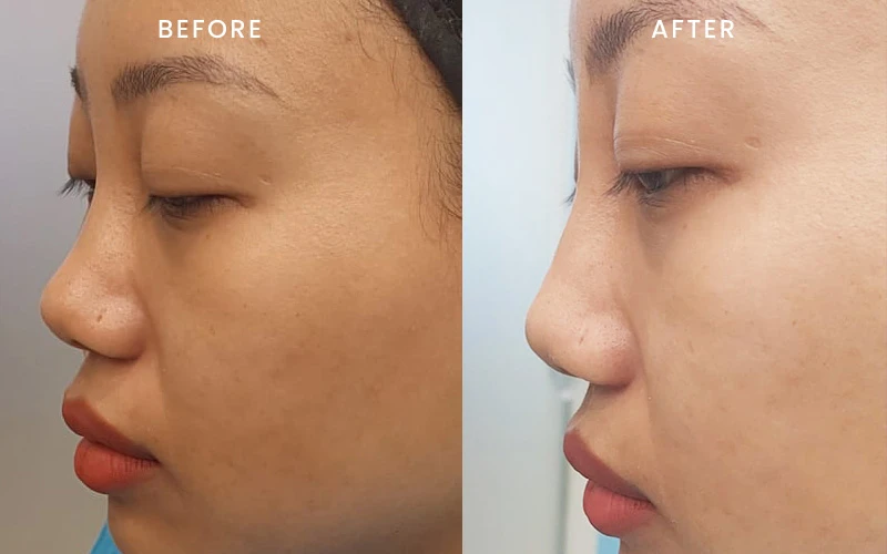 Facial enhancement result