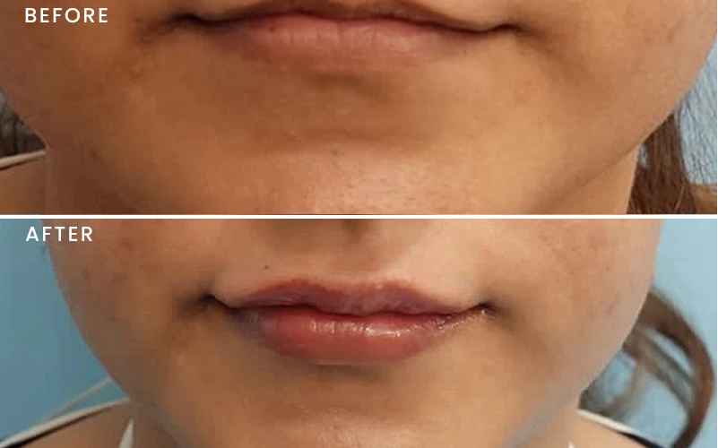 Anti-aging treatment result