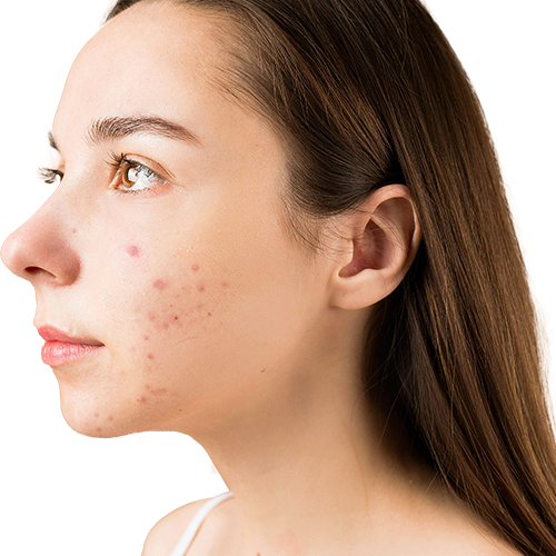 Acne Scar Treatment