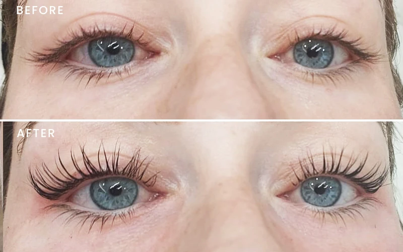 Eyebrow transplant results before after