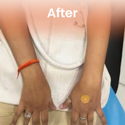 IV Glutathione therapy after Delhi