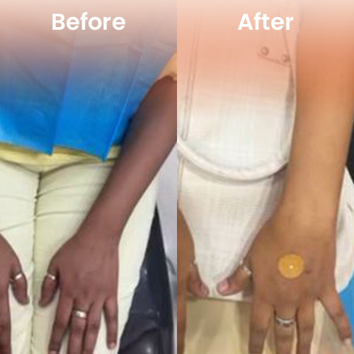 IV Glutathione before after Delhi