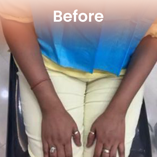 IV Glutathione treatment before Delhi