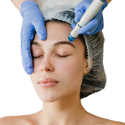 MNRF Treatment
