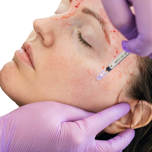 Vampire Facial (PRP)