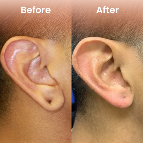 Male earlobe surgery result