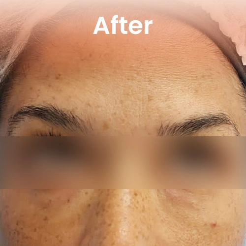 After Botox results