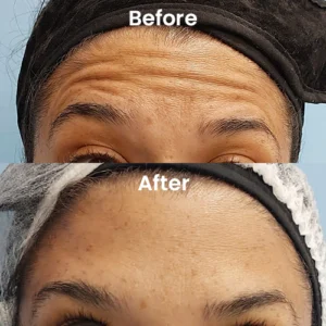 Botox treatment before and after – reduced wrinkles and fine lines